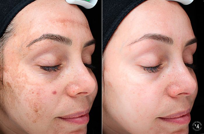 Peel peels peeling benefits acne hyperpigmentation tca glow glycolic retinol ultrasonic radiant